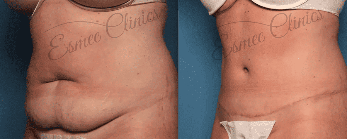 Before and After img